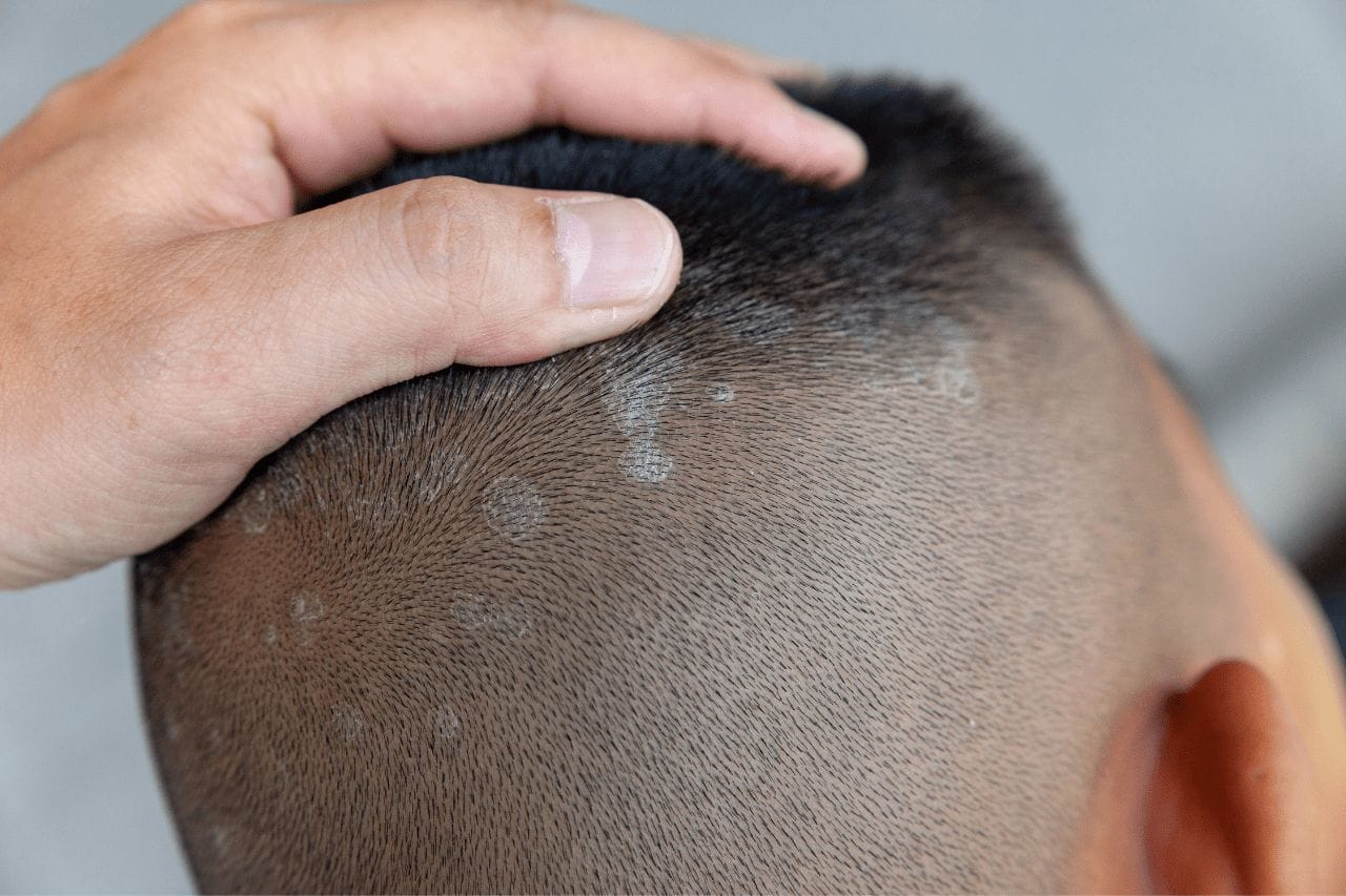 3-signs-of-eczema-on-the-scalp-hair-loss-topic