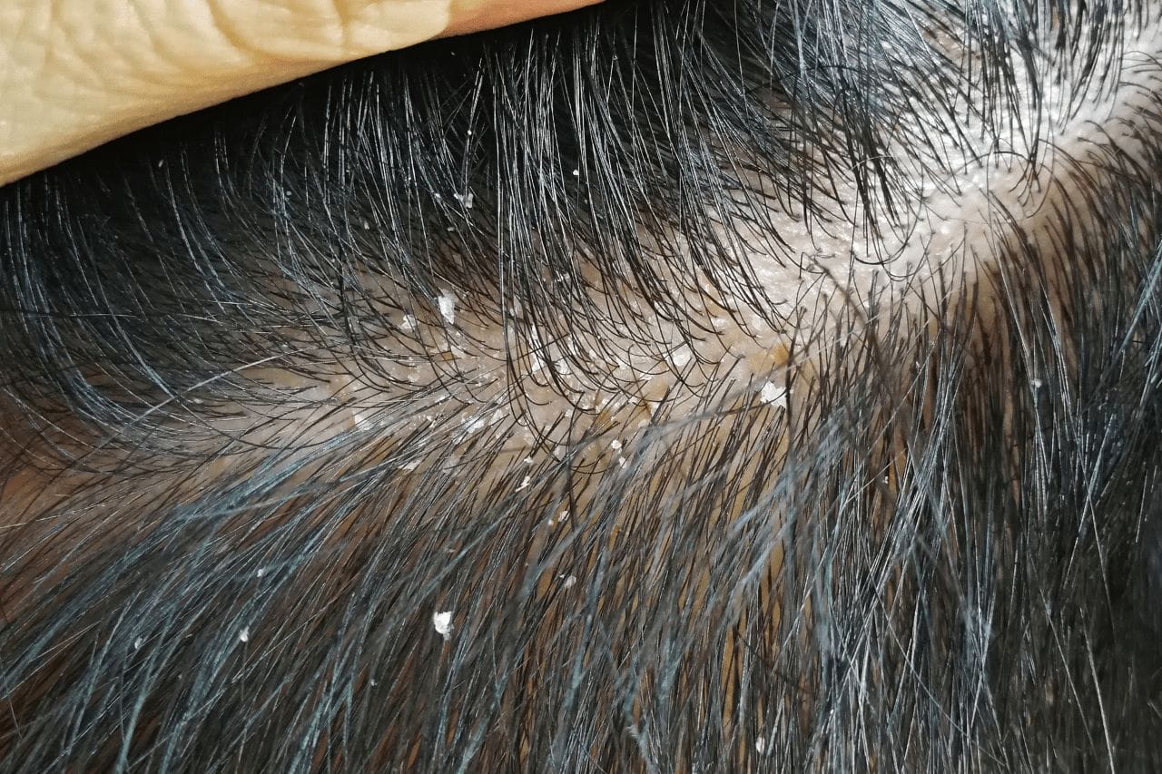 How To Treat Scalp Yeast Infection Hair Loss Topic 